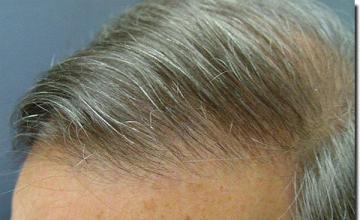 Hair restoration procedure results