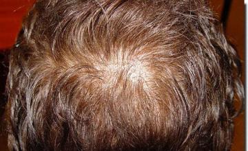 Hair restoration procedure results