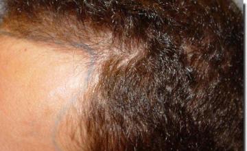 Hair restoration procedure results