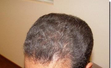 Hair restoration procedure results