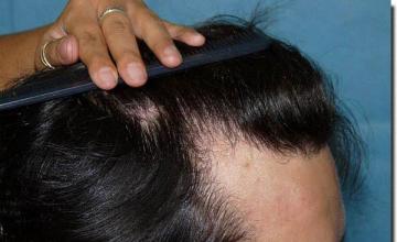 Hair restoration procedure results