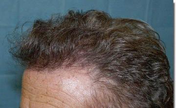 Hair restoration procedure results