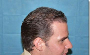 Hair restoration procedure results