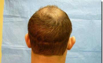 Hair restoration procedure results