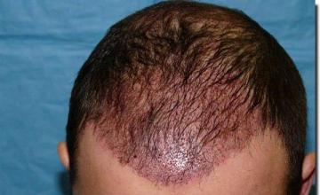 Hair restoration procedure results