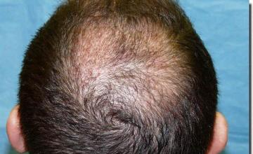 Hair restoration procedure results