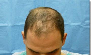 Hair restoration procedure results