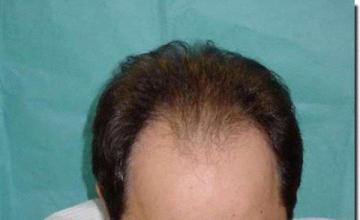 Hair restoration procedure results