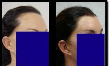 Hair restoration procedure results