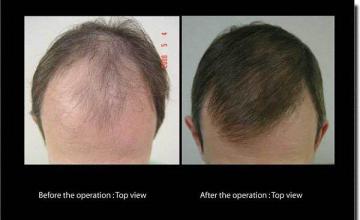 Hair restoration procedure results