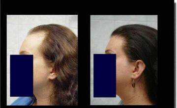 Hair restoration procedure results