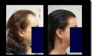 Hair restoration procedure results