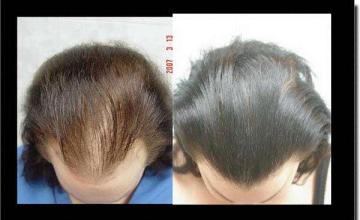 Hair restoration procedure results