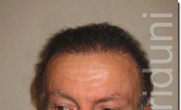 Hair restoration procedure results