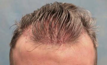 Frontal view post op