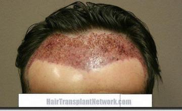 Hair restoration procedure results