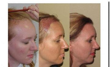 Hair restoration procedure results