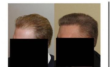 Hair restoration procedure results