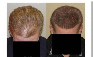 Hair restoration procedure results