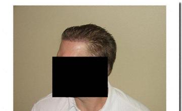 Hair restoration procedure results