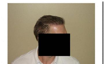 Hair restoration procedure results