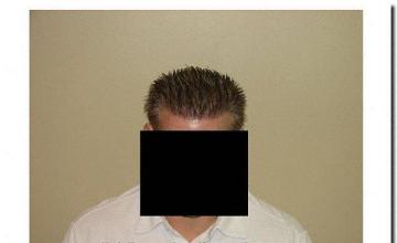 Hair restoration procedure results