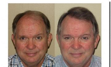 Hair restoration procedure results