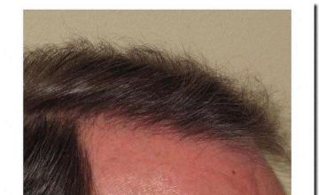 Hair restoration procedure results