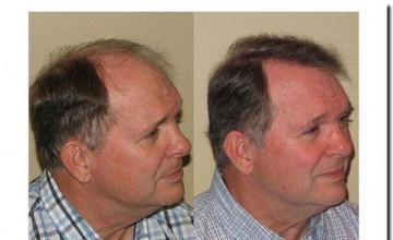 Hair restoration procedure results