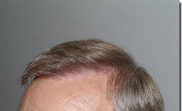 Hair restoration procedure results