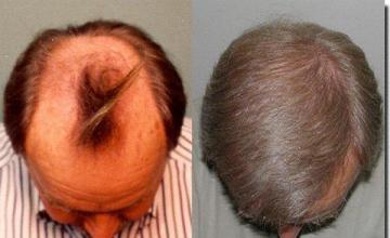 Hair restoration procedure results