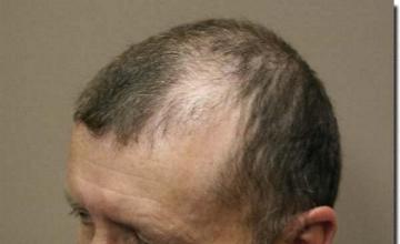 Hair restoration procedure results