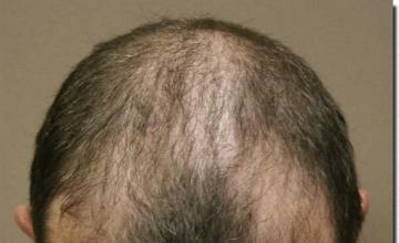 Hair restoration procedure results