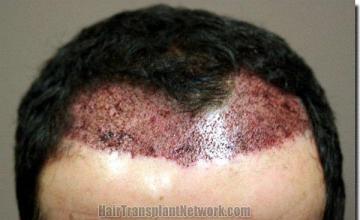 Hair restoration procedure results