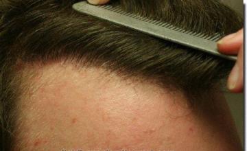 Hair restoration procedure results