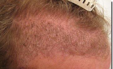 Hair restoration procedure results