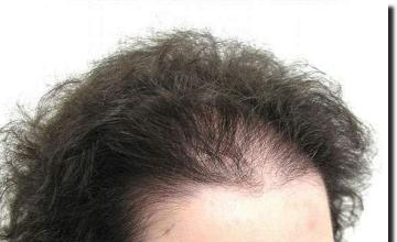 Hair restoration procedure results