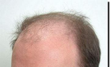 Hair restoration procedure results