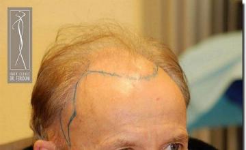 Hair restoration procedure results