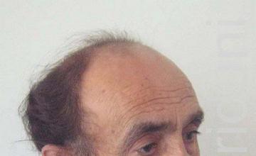 Hair restoration procedure results