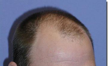 Hair restoration procedure results