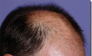 Hair restoration procedure results