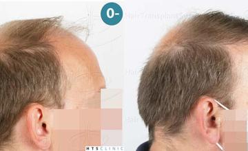 Right view of patient before and after