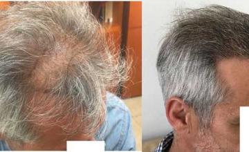 Right view before and after hair transplant surgery