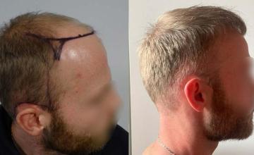 Right view of patient before and after