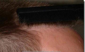 Hair restoration procedure results