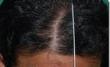 Hair restoration procedure results