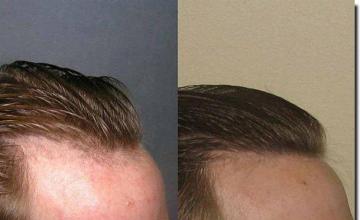 Hair restoration procedure results