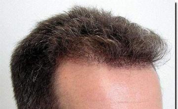 Hair restoration procedure results