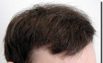 Hair restoration procedure results
